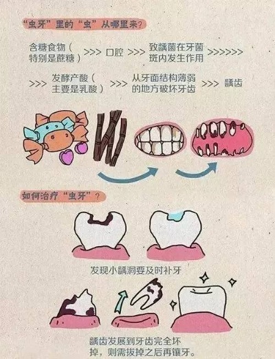 龋齿到底是个啥？全面科普，让你远离虫牙困扰